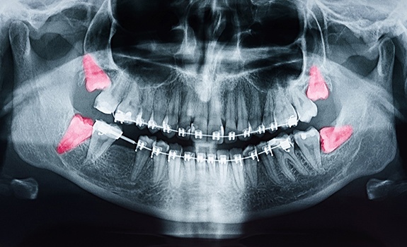 X-ray image of wisdom teeth in Rockwall, TX