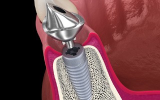 an example of osseointegration and an implant abutment 