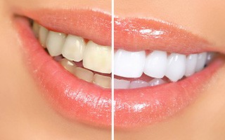 Before and after teeth whitening