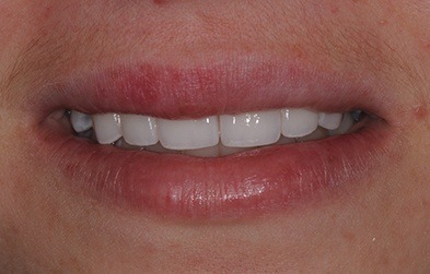 Congenitally missing teeth replaced with dental bridge