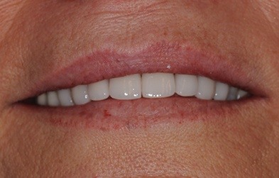 Patient's smile after full mouth restoration