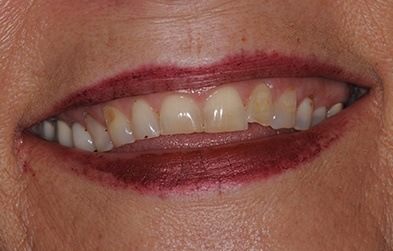Patient's smile before full mouth restoration