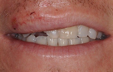 Patient's smile before cosmetic dental bonding