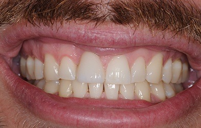 Top front tooth replaced with single tooth dental implant