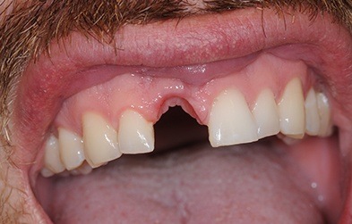 Patient with missing top front tooth
