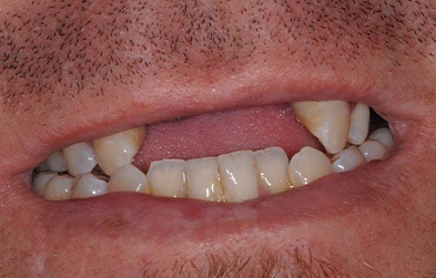 Smile with several missing front top teeth