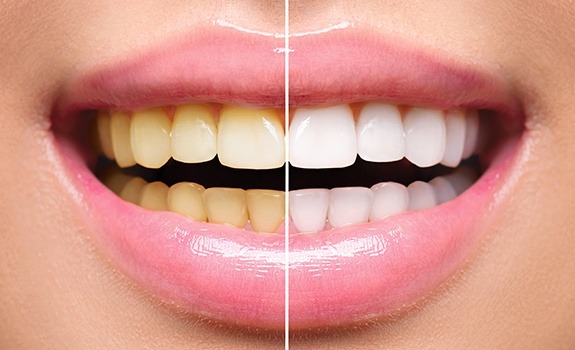 Smile before and after teeth whitening