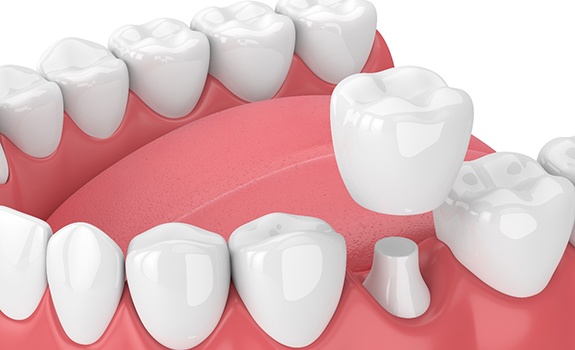 Diagram showing how dental crowns in Rockwall work