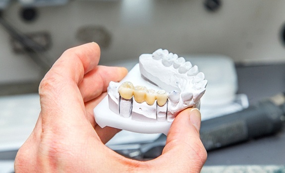 Dental bridge in Rockwall on jaw mold