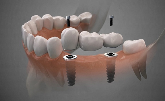 Digital illustration of dental implant bridge in Rockwall