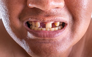 A closeup of a mouth with missing teeth