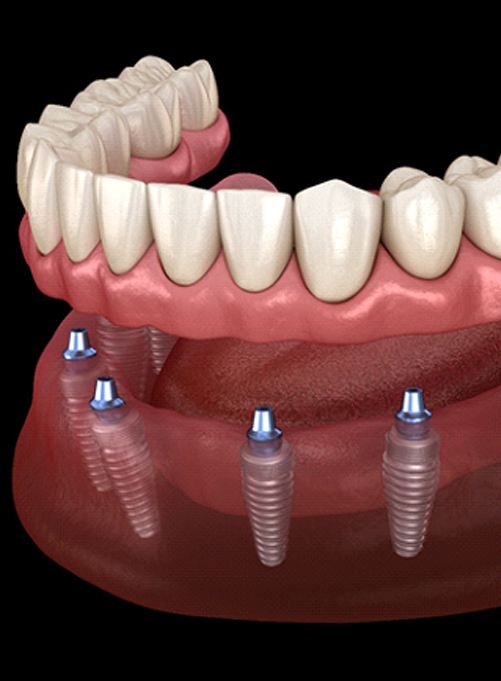 Implant denture in Rockwall