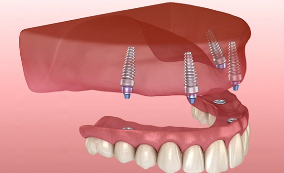 An implant denture in Mesquite