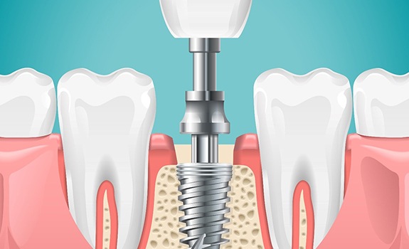 Diagram showing how a dental implant works