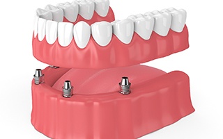 Illustration of dentures supported by dental implants in Rockwall, TX