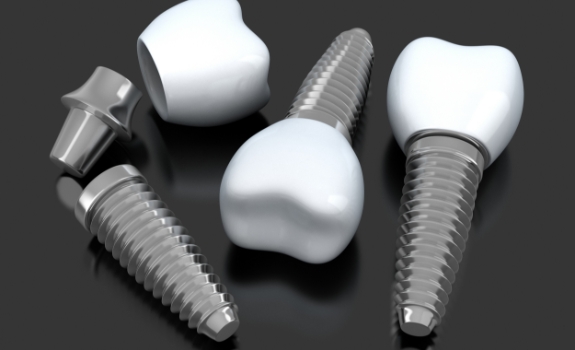 Three animated dental implant posts