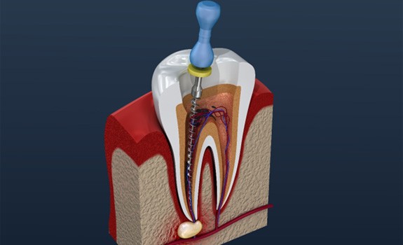 illustration of the process for root canal therapy in Rockwall