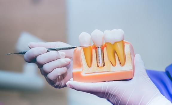 a person holding a model of a dental implant