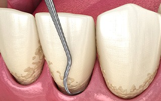 Illustration of scaling and root planing for gum disease in Rockwall, TX