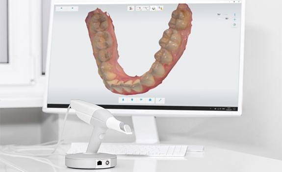 Digital bite impressions on chairside computer