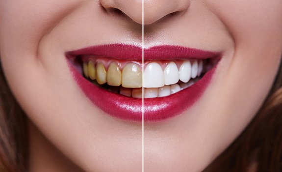 Closeup before and after comparison of teeth whitening in Rockwall