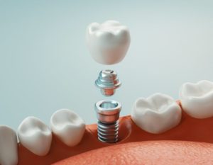 a computer-generated image of a dental implant becoming loose