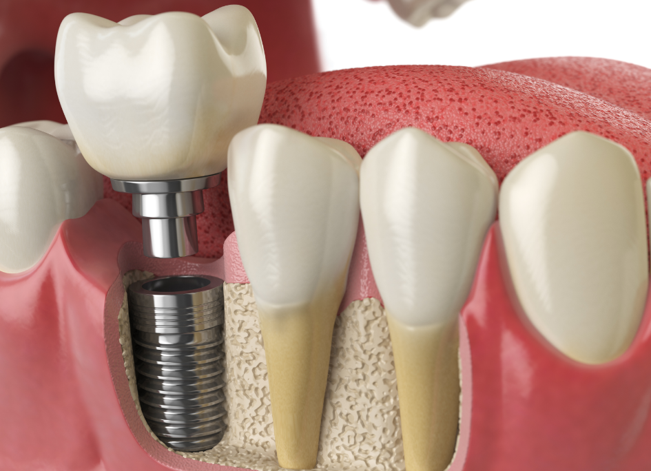 Cross section of a dental implant